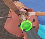 Nail it! Vision-based Drift Correction For Accurate Mixed Reality Surgical Guidance
